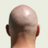 baldtyre